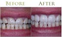 oral teeth whitening before and after