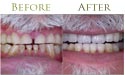 oral tooth whitening before and after