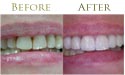 Dental teeth whitening before and after